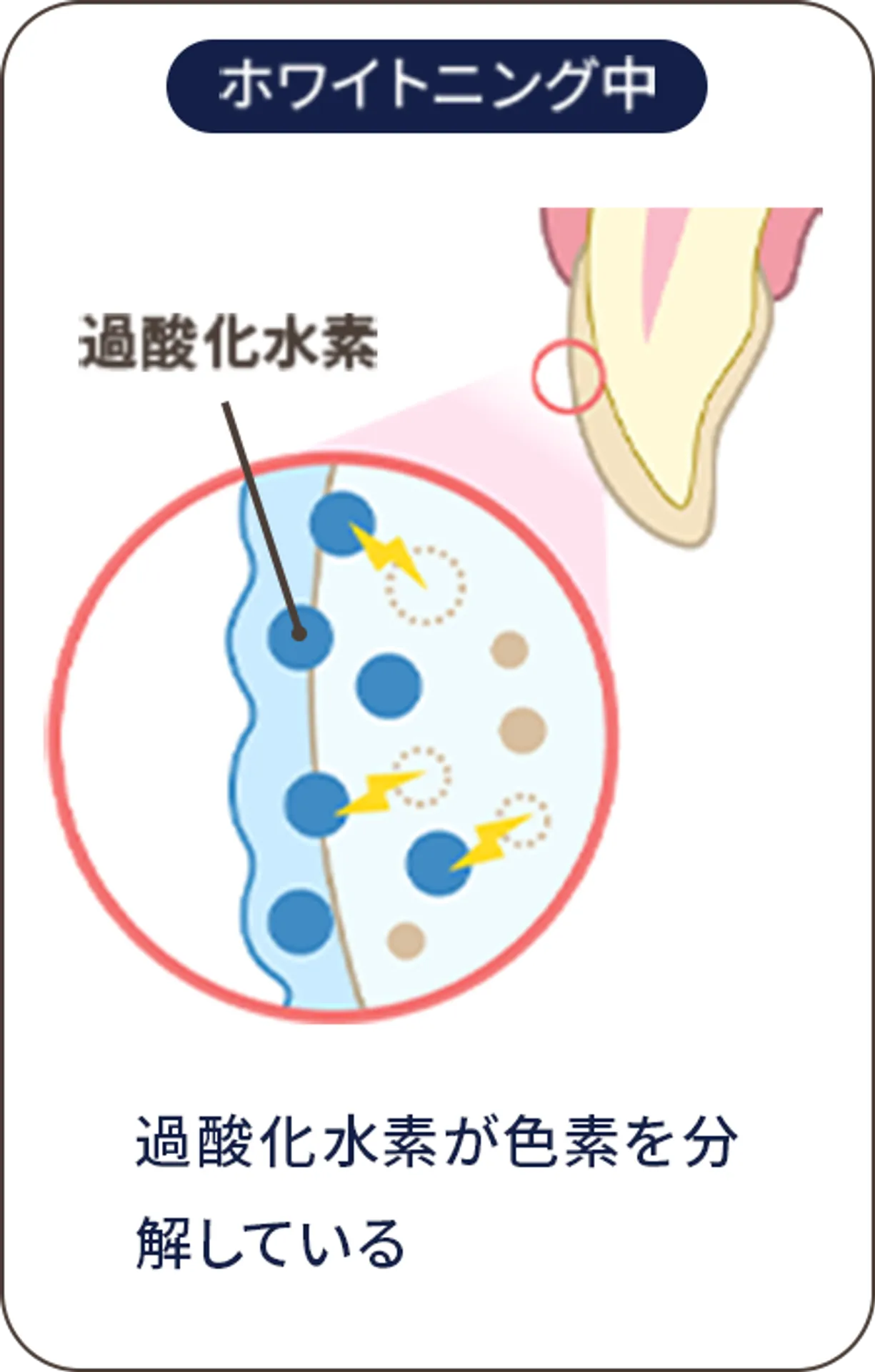 ホワイトニング中